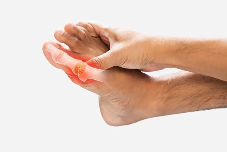 What is a Tailor’s Bunion?